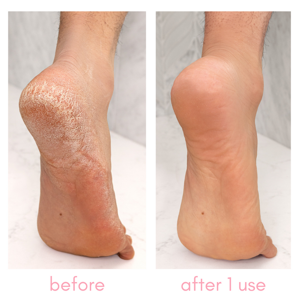 Heel-ing Callus Remover