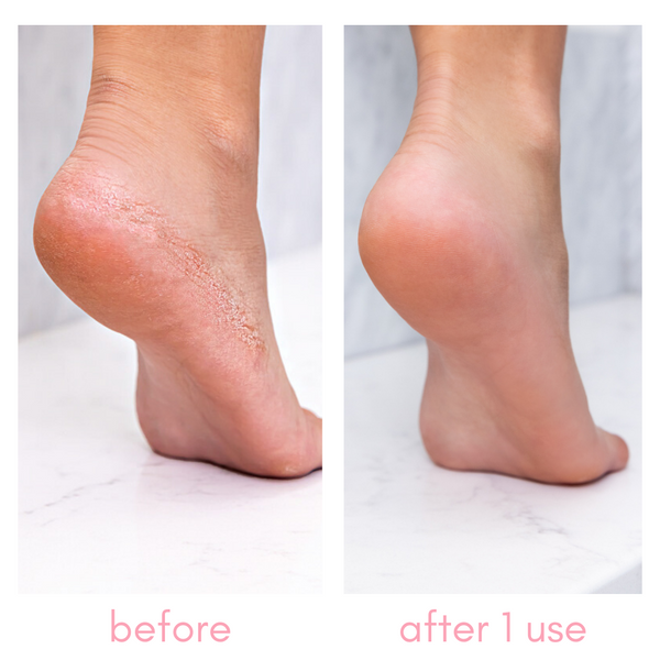 Heel-ing Callus Remover