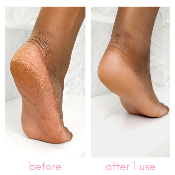 Heel-ing Callus Remover